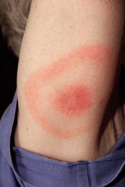 Lyme disease