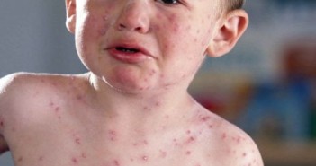 Chickenpox